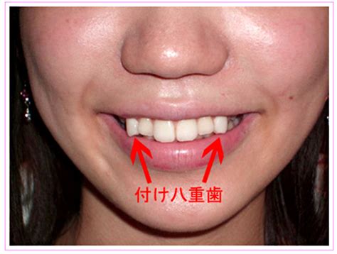 In Japan A Trend To Make Straight Teeth Crooked Noticed The New