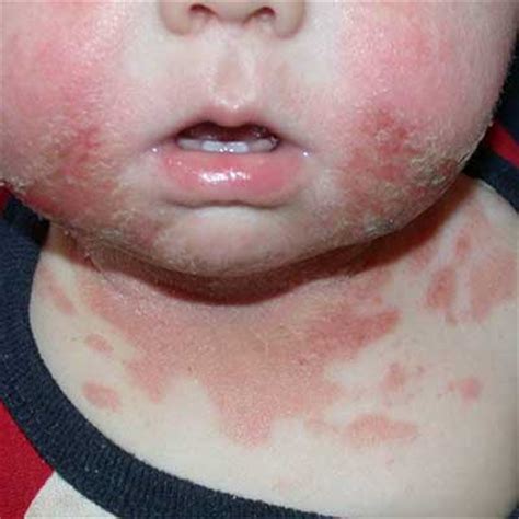 From viral infection rash to food sensitivities to the fever and rash toddlers can experience from roseola. Pictures of Skin Allergies in Children