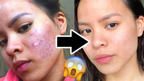 They are a feature of mild acne, and handling blackheads in the right way can help to prevent the acne from becoming more severe. How to REALLY Get Rid of Acne Scars FAST! - YouTube