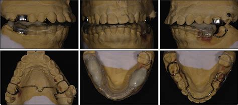 Figure 4 From Orthodontic Uprighting Of A Horizontally Impacted Third