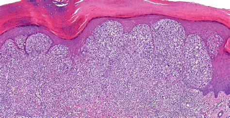 Invasive Melanoma Histology