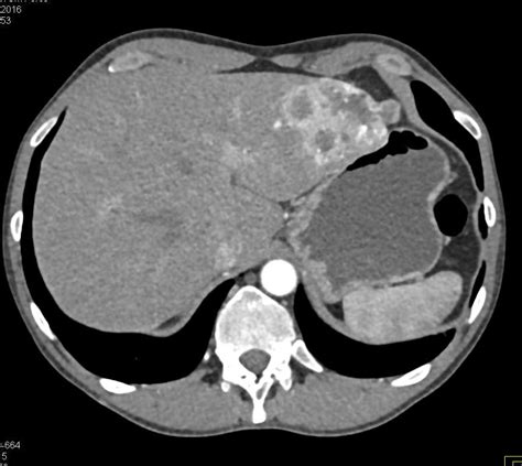 Metastatic Renal Cell Carcinoma Kidney Case Studies Ctisus Ct Scanning