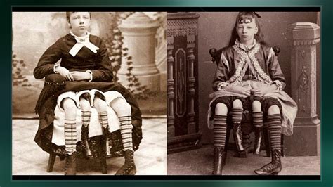 From the waist down, she was two separate people, having two pelvises, two complete. Myrtle Corbin - YouTube