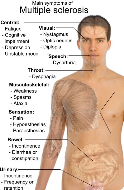 Multiple Sclerosis Prognosis Overview Symptoms Of Health