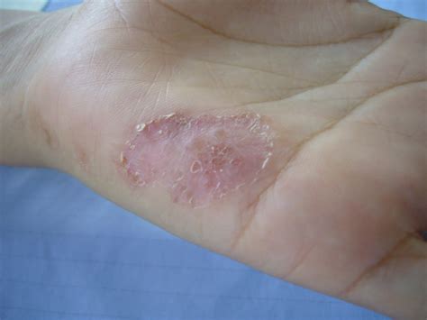 Rash On Hands And Feet Only Pictures Photos