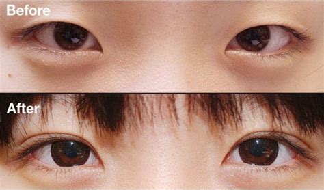 Double Eyelid Surgery In Korea What You Need To Know Jivakacare