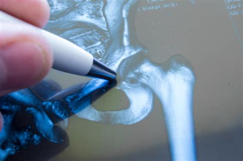 Hip Arthroscopy • Koth Orthopedics And Spine