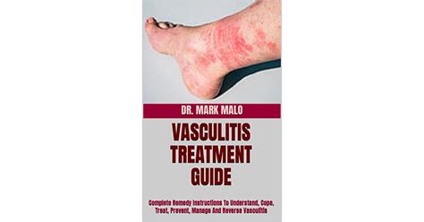 Vasculitis Treatment Guide Complete Remedy Instructions To Understand