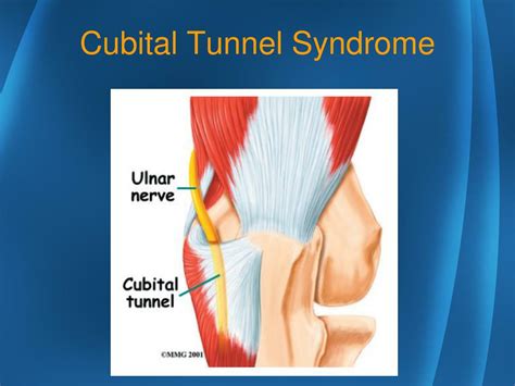 Cubital Tunnel Syndrome Definition Symptoms Causes Images