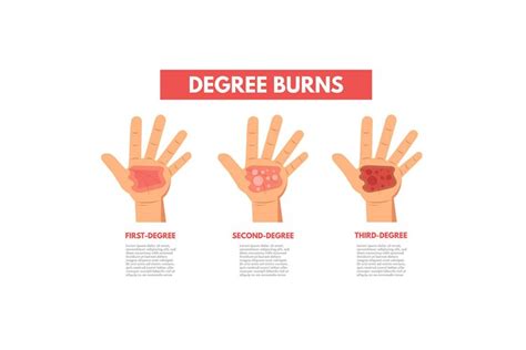 Degree Burns Of Skin Infographic Vector 703738