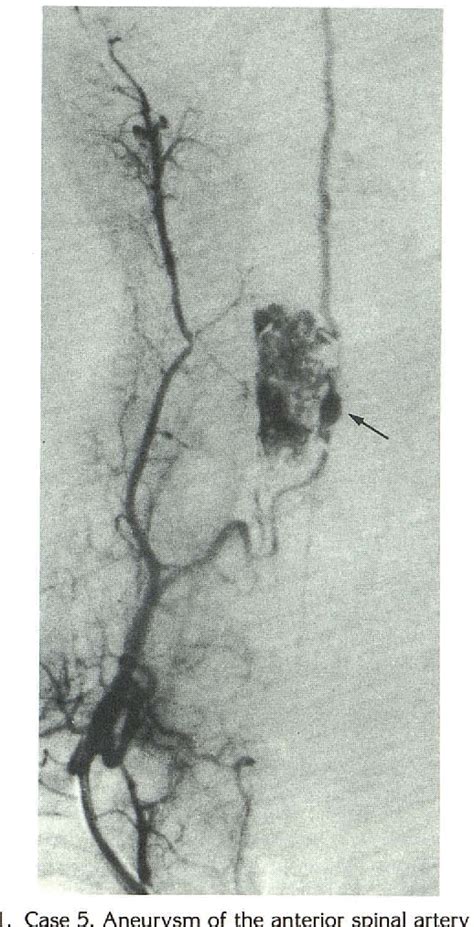 Figure From Aneurysms Of Spinal Arteries Associated With