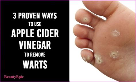 Apple Cider Vinegar For Wart Removal Cider Vinegar Apple Cider