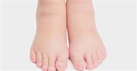 Swollen Feetcauses And Treatment Teller Report