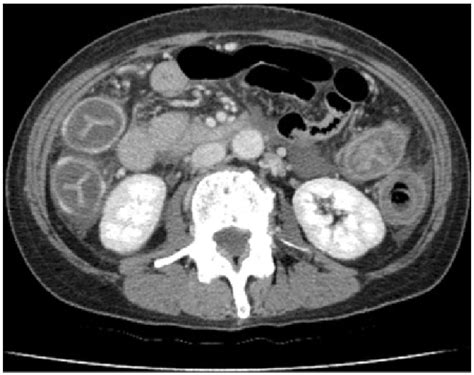 Contrast Enhanced Ct Scan At The Level Of The Kidney Showing Wall