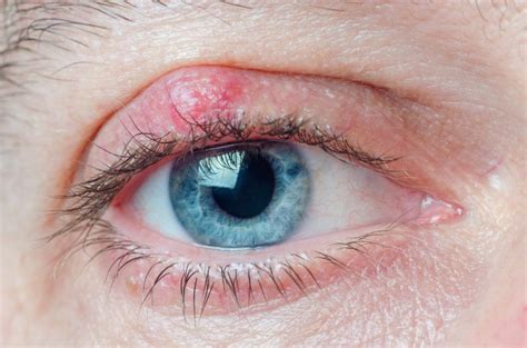 Eyelid Cyst Chalazion Causes Symptoms Treatment Eyelid Cyst