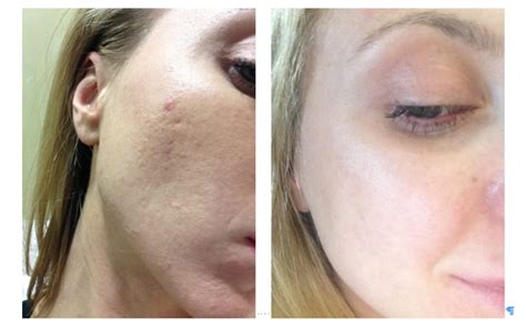 Before And After From A Patient Who Had Co2 Laser And Prp Vampire