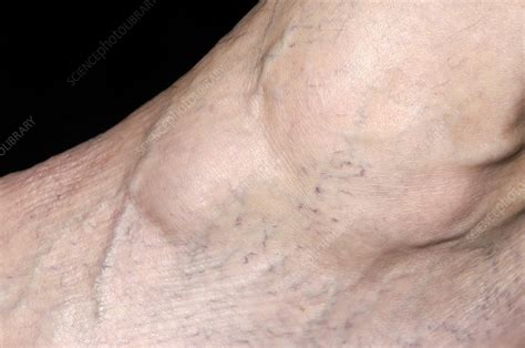 Ganglion Cyst Stock Image C0024844 Science Photo Library