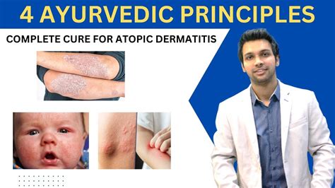 Atopic Dermatitis How To Get Rid Of Eczema Naturally And Permanently By