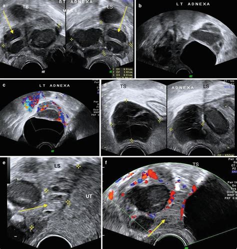 Ultrasound Evaluation Of Adnexal Pathology Obgyn Key