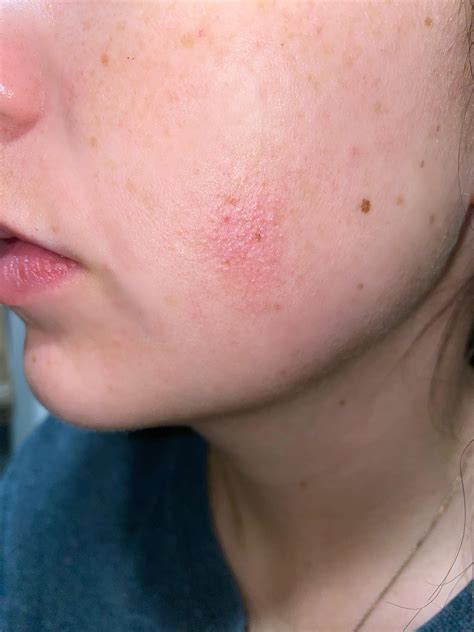 Pin On Skin Rash On Face Images