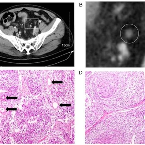 A Contrast Enhanced Equilibrium Phase Ct Scan Images Of A Lymph Node