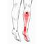 Tibialis Posterior – Pain & Trigger Points