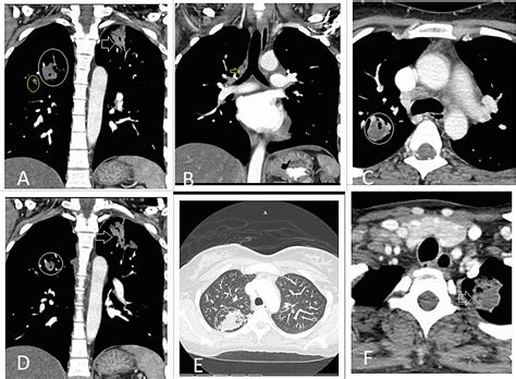 Cureus An Adult Female Presenting With Scrofula Tubercular