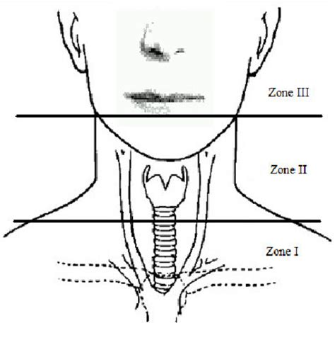 Schematic Representation Of The Three Zones Of The Neck Download