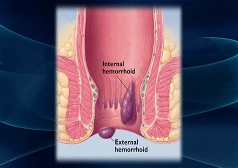 Like internal hemorrhoids, external ones may protrude through the anus. Methods of Hemorrhoid Treatments
