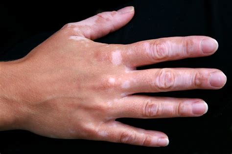What Are The Symptoms Of 1st Stage Vitiligo