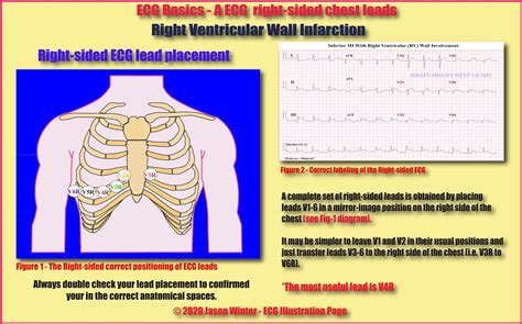 Ecg Educator Blog Right Ventricular Wall Infarction