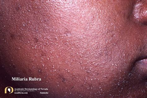 Miliaria Rubra Heat Rash Prickly Heat Academic Dermatology Of Nevada