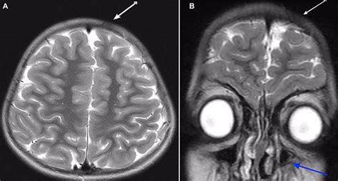 Cureus Ipsilateral Hemispheric Brain Atrophy In An Asymptomatic Child