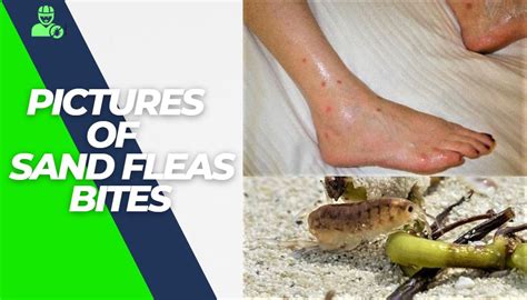 Top Pictures Of Sand Flea Bites Abdul Muqeet