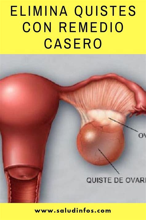 Elimina Quistes Con Remedio Casero Remedios Caseros Casero