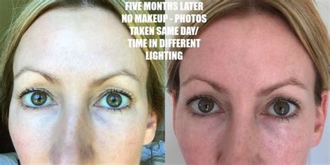 Laser For Wrinkles Under Eyes Knepeledward