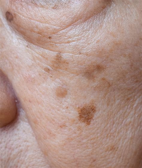 Brown Spots Treatment Mclean And Potomac Dermatology