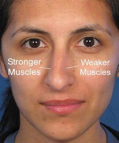 Check spelling or type a new query. Fixing a Crooked Nose using Nose Exercises | Crooked nose, Big nose beauty, Bulbous nose