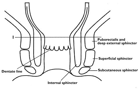 transrectal sonography of anal sphincter infiltration in lower rectal carcinoma ajr