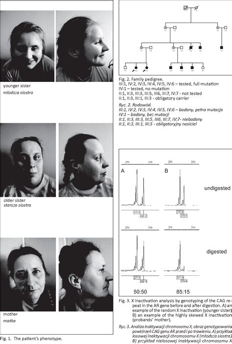 Fragile X Syndrome In Females A Familial Case Report And Review Of