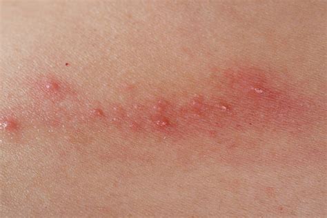 Royalty Free Exfoliative Dermatitis Pictures Images And Stock Photos