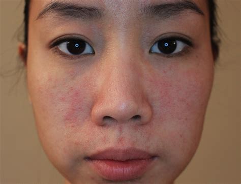 Allergic Reaction Face Pictures Photos