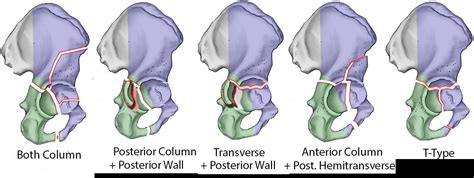 Acetabular Fractures Trauma Orthobullets
