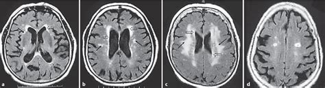 Figure 1 From Brain Lesions On Mri In Elderly Patients With Type 2