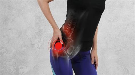Gluteal Tendinopathy Causes Symptoms Diagnosis And Treatment Reliefly