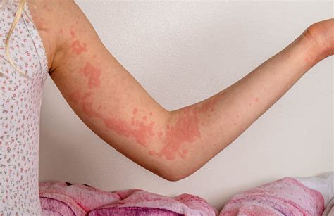 How To Treat Eczema And Other Skin Conditions And When To See A Doctor