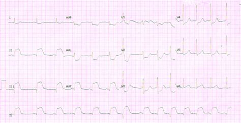 Twelve Lead Electrocardiogram Showing St Elevations In Inferior Leads