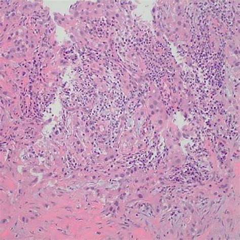 Histological Confirmation Of Metastatic Renal Cell Carcinoma From The