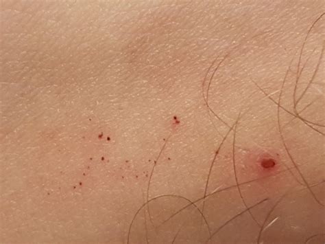 Found Bed Bug Bites On My Leg Fml Rbedbugs