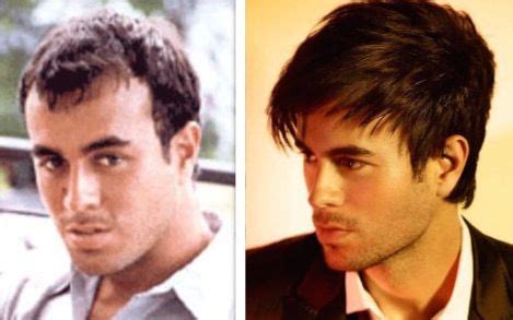 Enrique Iglesias Bald Before Hair Transplant Plastic Surgery